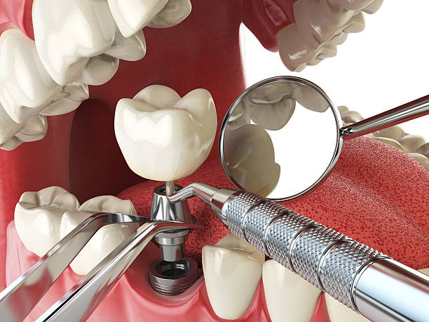 Best Emergency Tooth Extraction in Bellmead, TX